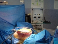 Хирургический подход улучшает выживаемость при распространенном раке яичника